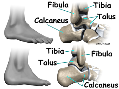 Ankle Impingement Problems
