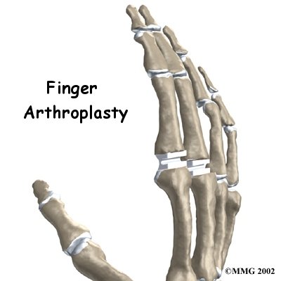 Artificial Joint Replacement of the Finger - Peak Physical Therapy's Guide