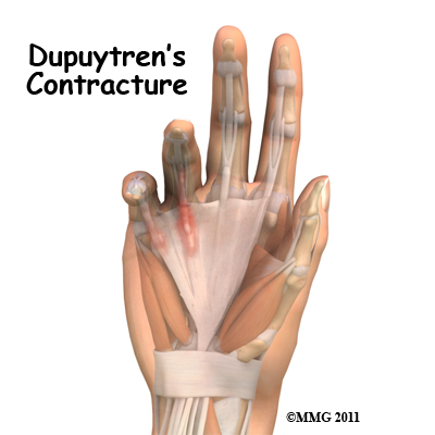 Dupuytrens Contracture Patient Guide
