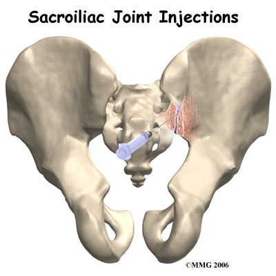 Sacroiliac Joint Injections