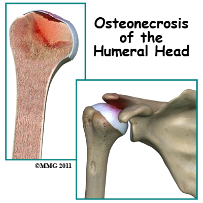 Osteonecrosis of the Humeral Head
